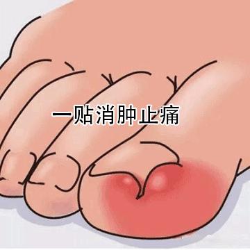 趾甲扎进肉里了，一碰就痛？用它一贴，1分钟止痛，趾甲往外长，再也不扎痛了！