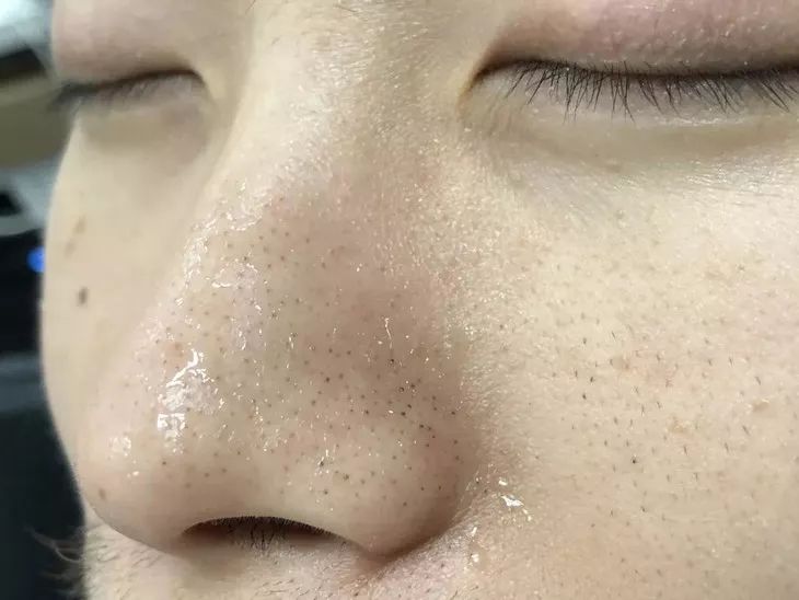 白头黑头到底拔不拔,黑头反反复复如何根治