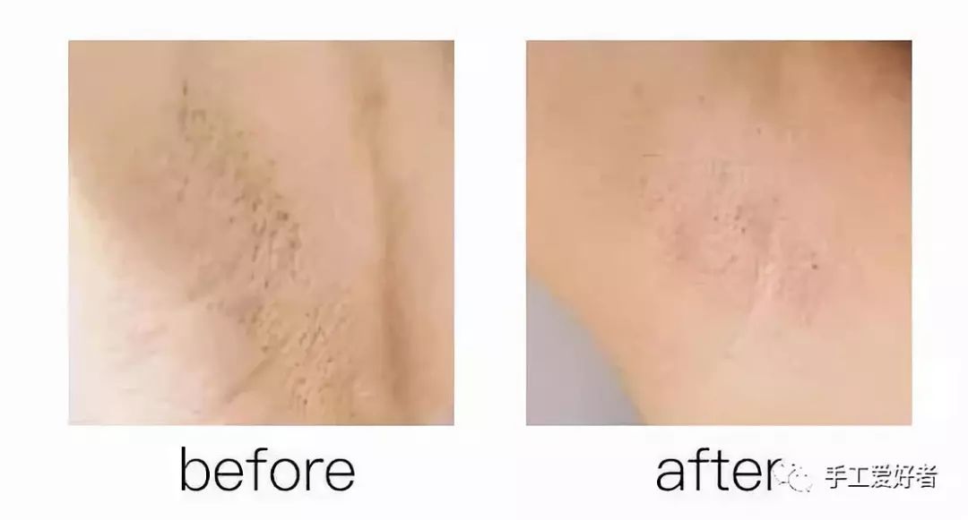 平价又好用的脱毛神器学生党温和,英国脱毛最好的产品适合学生党