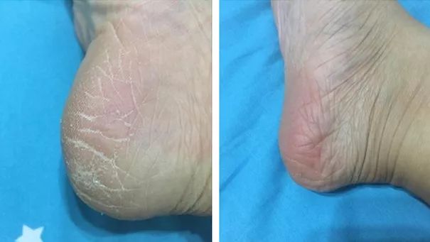 一招告别死皮老茧脚,去脚后跟老茧死皮的法子