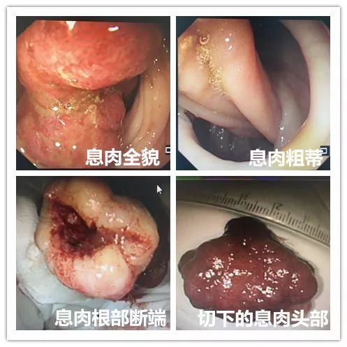 切除肠道小息肉,切掉肠道息肉