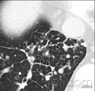 胸部解剖及常见疾病影像表现,胸部影像学基础知识