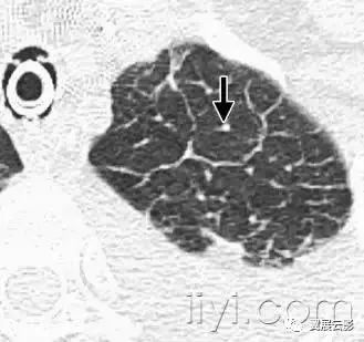 胸部解剖及常见疾病影像表现,胸部影像学基础知识