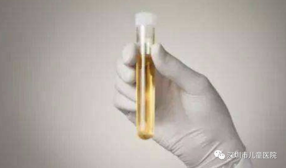 尿尿泡沫多是肾阴虚还是肾阳虚,小孩小便有泡沫是不是肾有问题