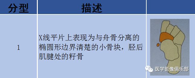 足副骨综合征,副舟骨疼痛综合征