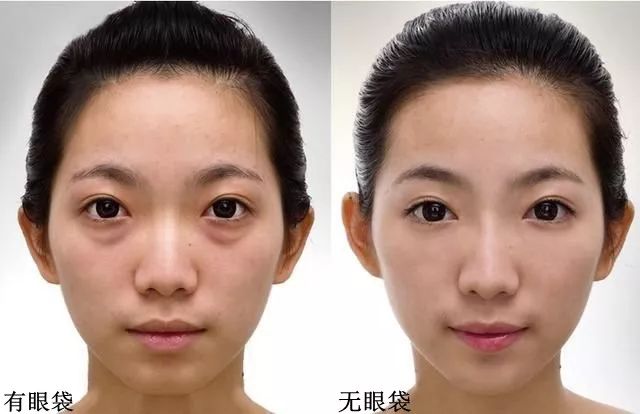 解决眼袋只需3步,不管眼袋多严重用点它