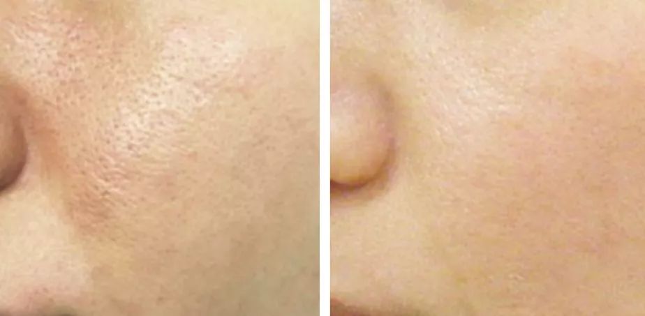 适合黄皮干皮用的面膜,黄皮黑皮适合用的面膜