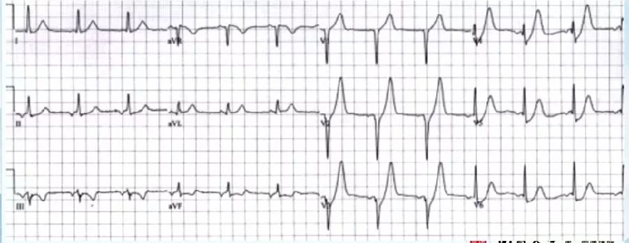 陈静：胸痛心电图的诊断与鉴别诊断｜CCIF2019
