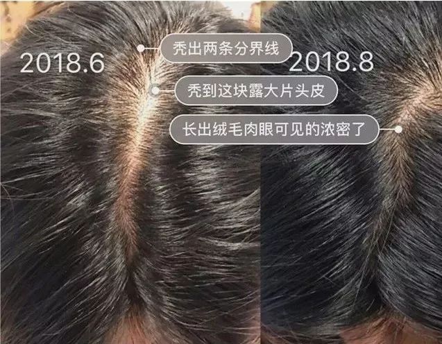 现在市场上脱发育发露有效果吗,防脱育发露对雄激素脱发有效果吗