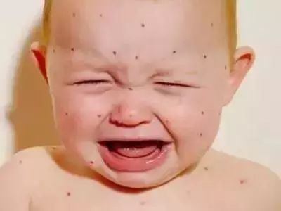 战痘最好的攻略,水痘战痘知识