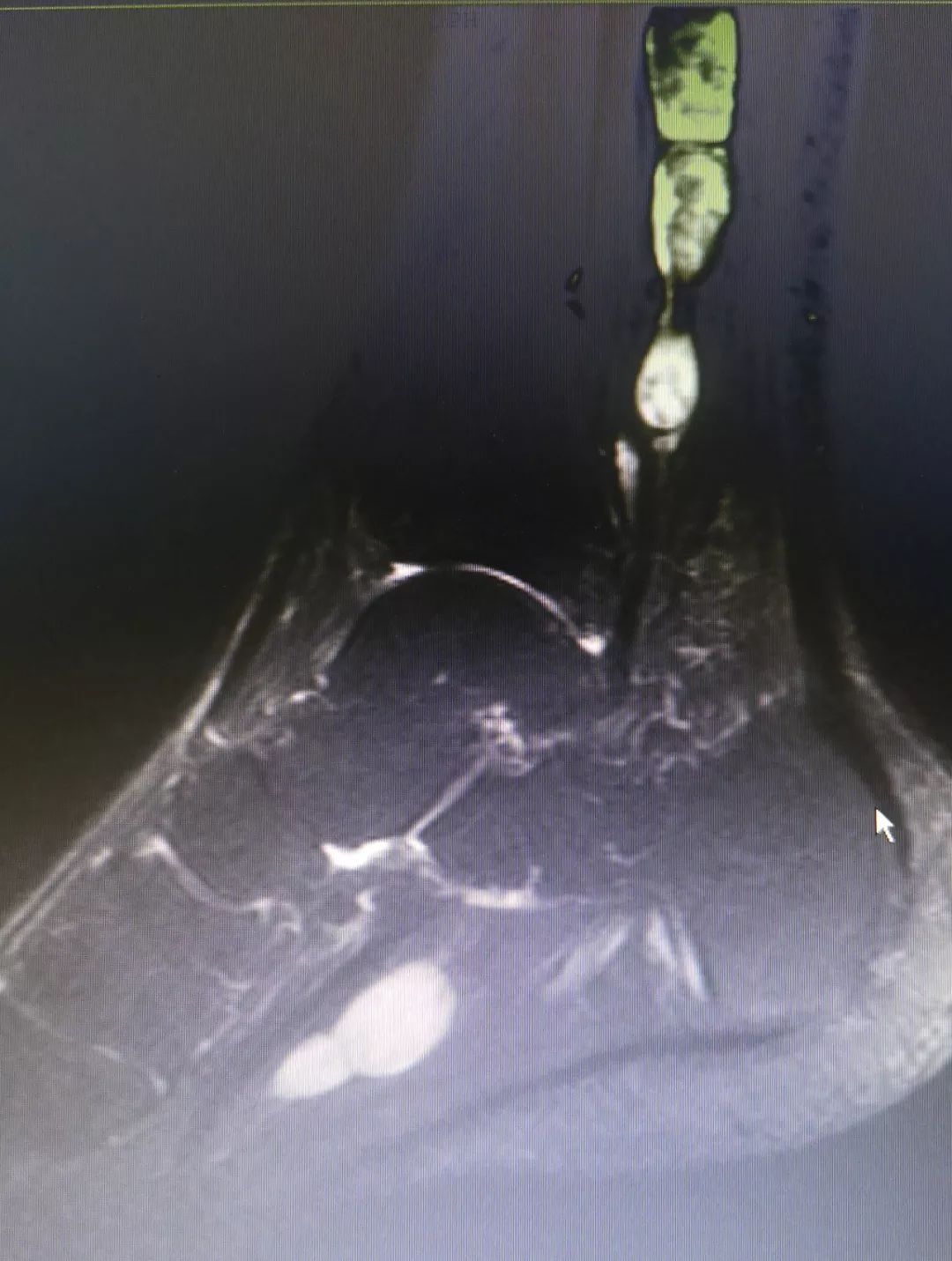 这可不是“烤肉串”!这是骨肿瘤专家妙手切除的神经鞘瘤