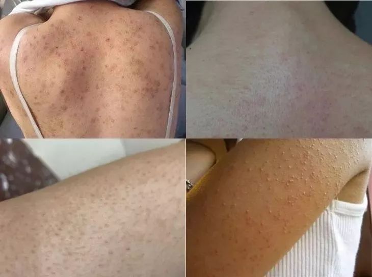 螨虫在脸上爬好不好,螨虫爬过的东西还能用吗