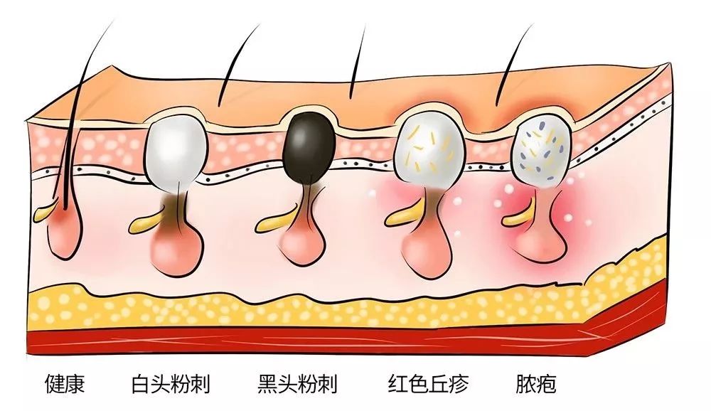 黑头太顽固教你去黑头的方法,去黑头小妙招你的黑头有救了