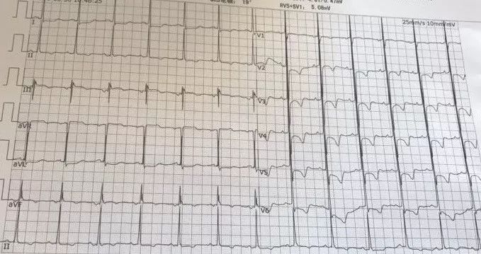 st压低t波倒置严重吗,st段压低和t波倒置