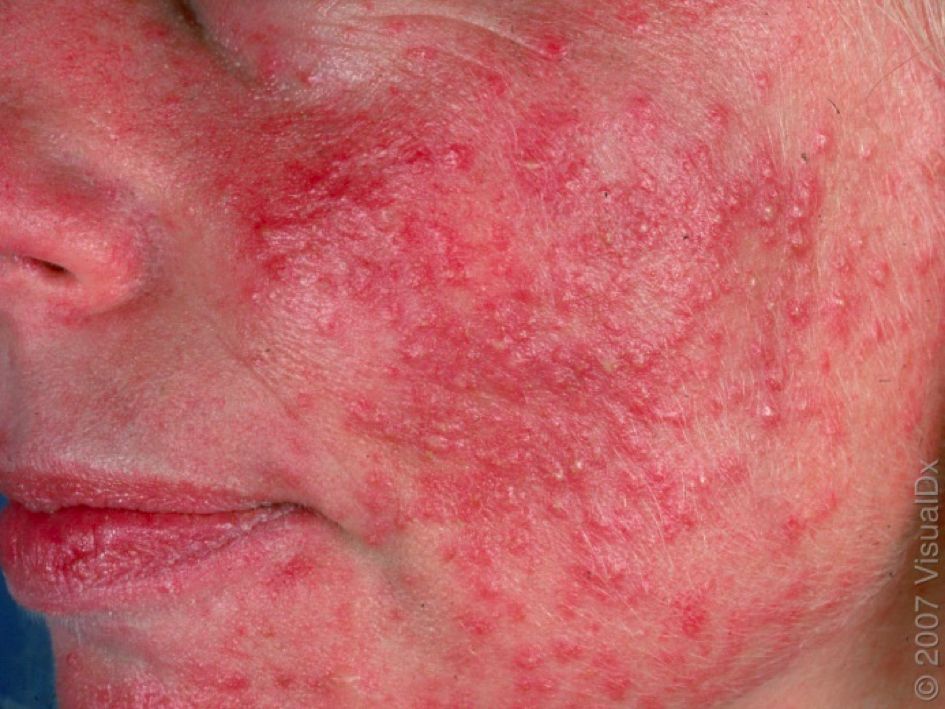 哪种皮肤病容易被误判为银屑病,容易被误诊为疥疮的皮肤病