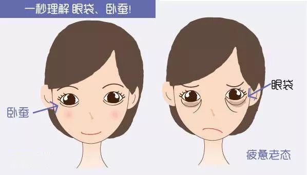 祛眼袋后卧蚕过于肥大怎么改善,眼袋卧蚕怎么消除简单方法