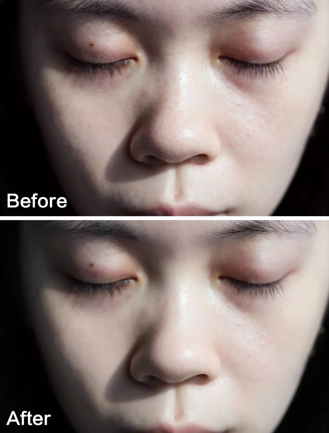 痘痘黑头清理方法,彻底解决痘痘黑头