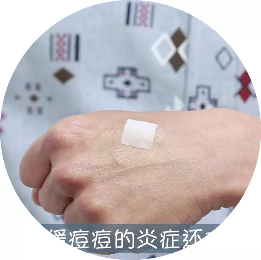 要你好看|听过很多祛痘方法，却还是收拾不了“车祸脸”？