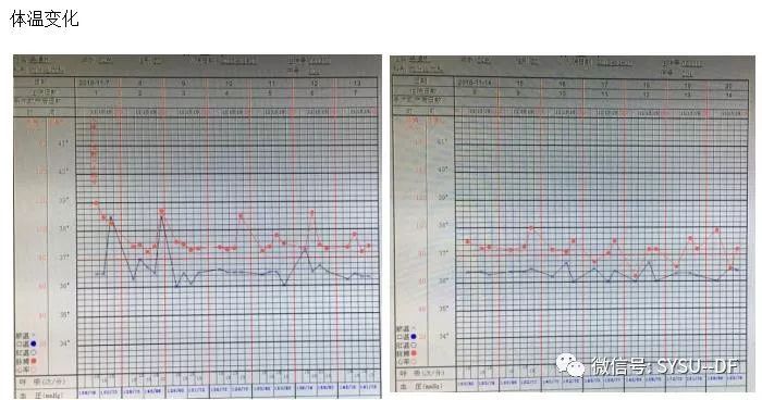 负压吸引糖尿病足的应用,负压滴灌治疗糖尿病足优势是什么