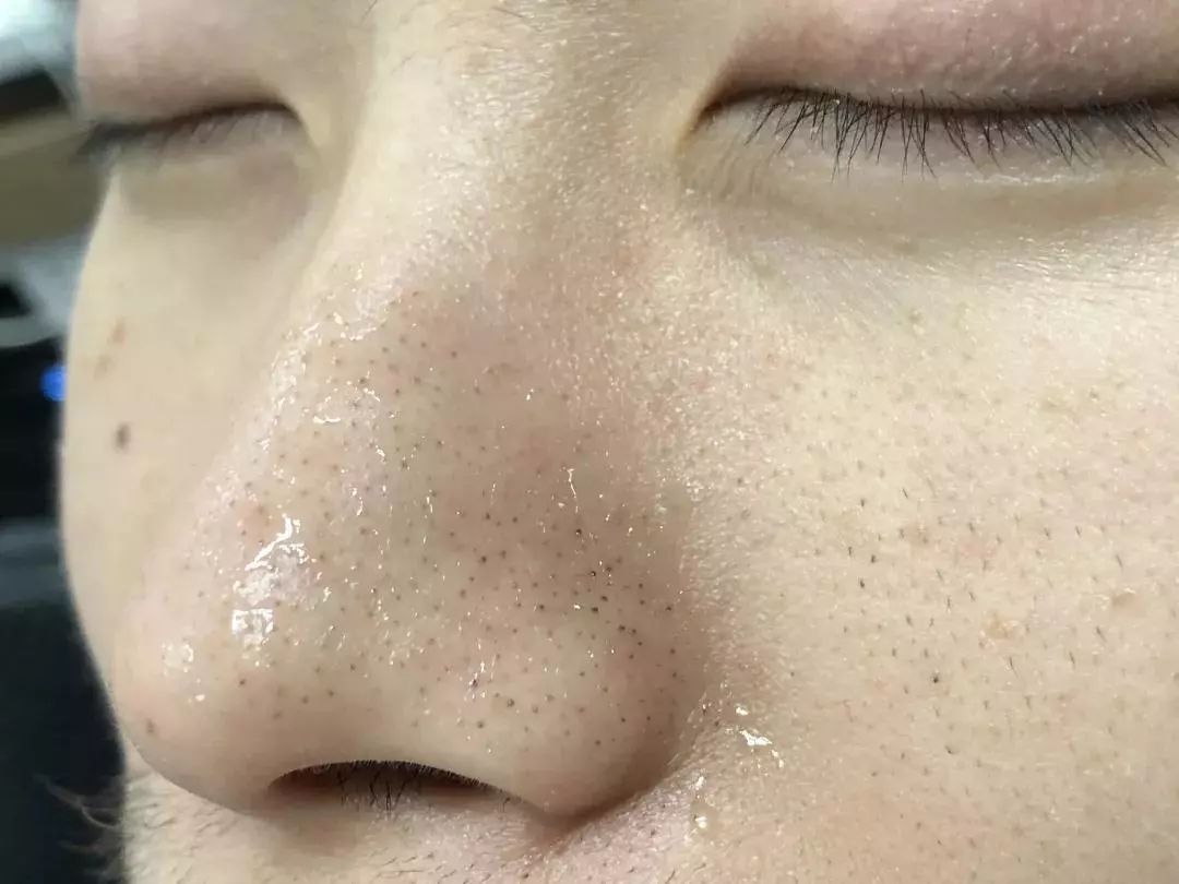 怎么把脸上的黑头清掉,去黑头推荐全脸