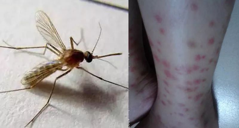 泰国蚊子咬止痒膏,防蚊虫叮咬药膏推荐泰国