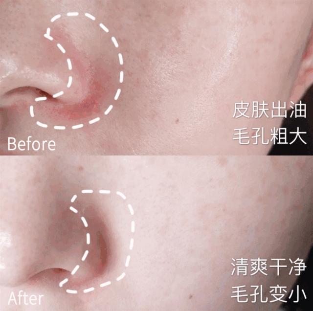 皮肤清洁出黑色的东西,皮肤挤出白色膏状很臭怎么办