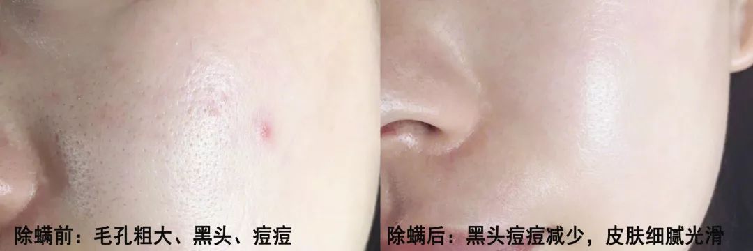 为什么能从鼻头上挤出白色的东西,鼻子挤出来的白丝是什么