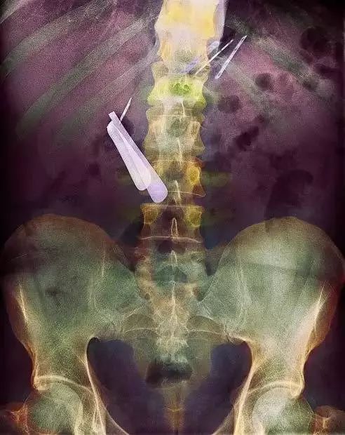 16张非常恐怖的X光照片