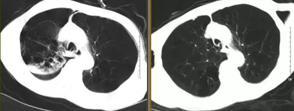 支气管镜热消融术治疗慢阻肺,西京医院支气管镜