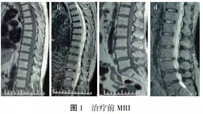 【病例分析】自发性椎管内硬膜外血肿保守治疗1例报告