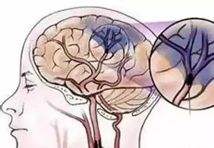 出现脑血栓的前兆怎么办,脑血栓怎样预防吃什么药有效