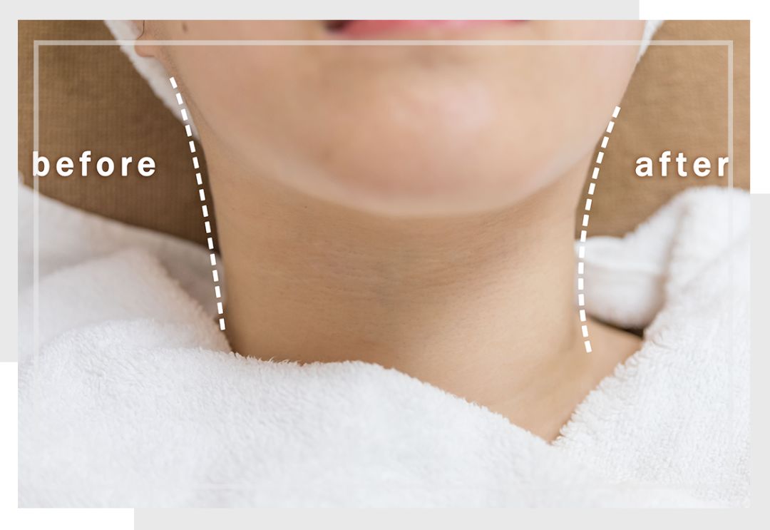 面部提拉无针埋线,无针埋线有护肤效果吗