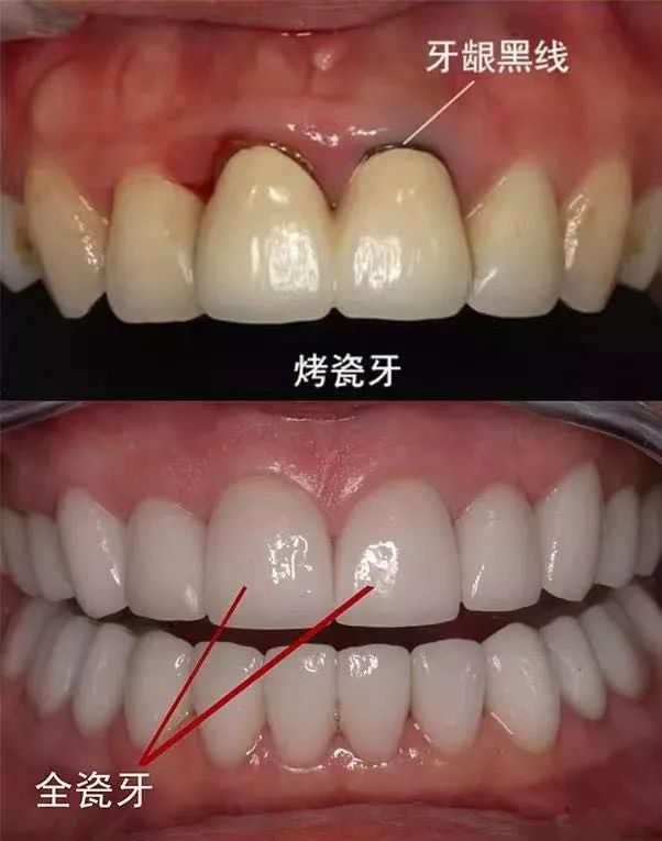 烤瓷牙和全瓷牙的内幕,烤瓷牙和全瓷牙普通人怎么区分