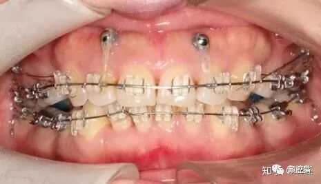 一笑露牙花子能矫正么,一笑就露出牙花怎么办