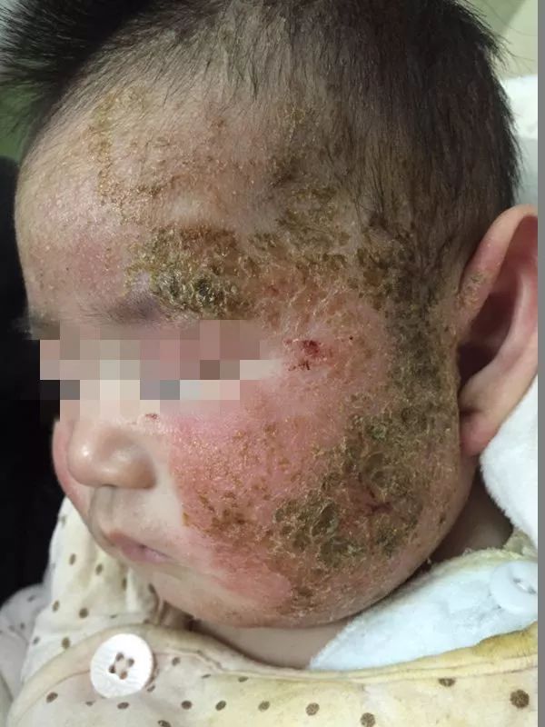 孩子湿疹总不好？医生见到都心疼了……