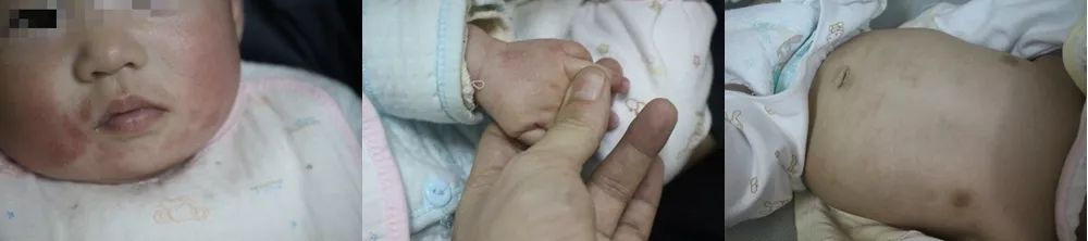 医生说湿疹不一定是坏事为什么,孩子湿疹不好一直用激素药膏