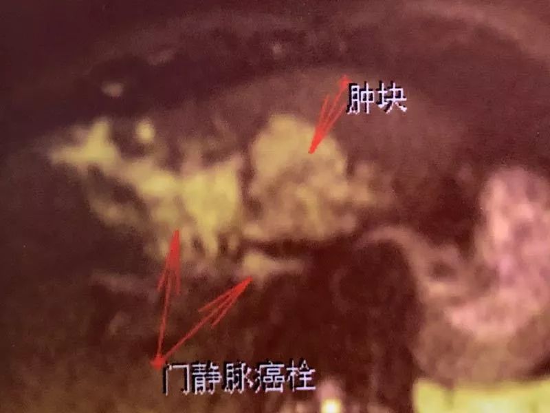 肝癌合并门静脉癌栓怎么办,纳米刀成对付癌中王的新利器