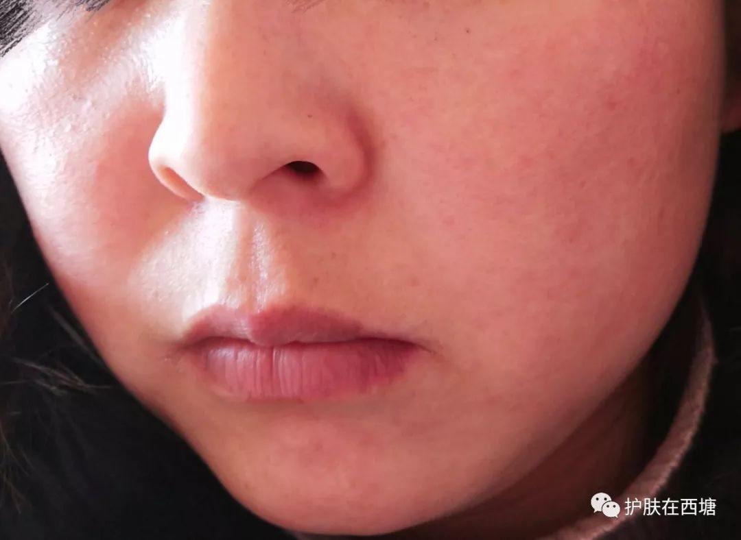 面部敏感性皮炎科普知识,激素依赖性皮炎是什么皮肤病