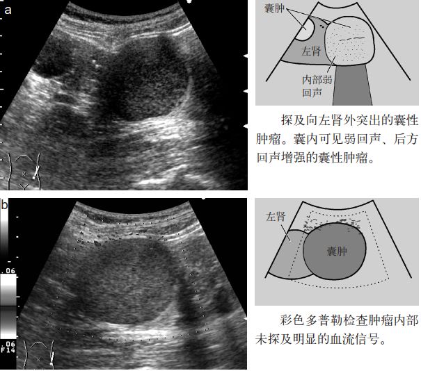 肾盏憩室和肾囊肿b超表现,肾盏憩室误诊肾囊肿案例