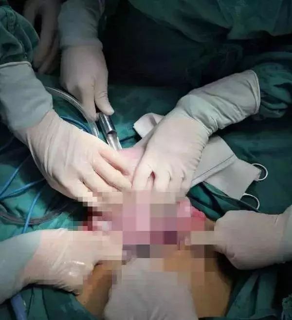 21岁，连续3次手术，输血量相当于把全身血换了3遍，差点就救不回来...