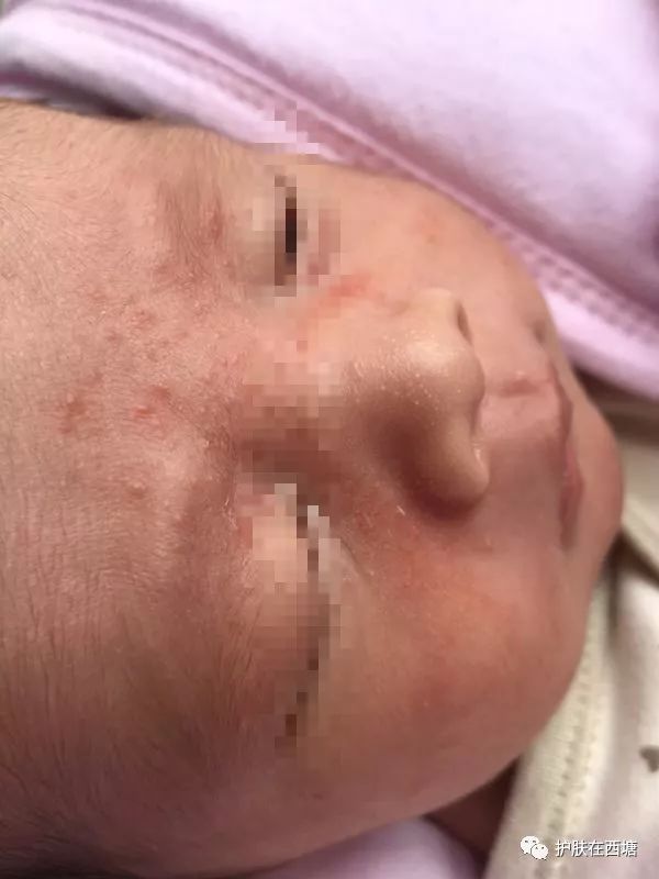 他克莫司软膏治疗脂溢性皮炎,面部皮肤脂溢性皮炎治疗方法