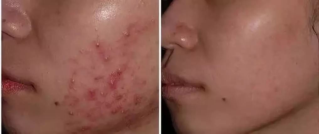 肉眼可见的除螨效果，日本爆款除螨贴，24小时不间断，除螨率高达97%