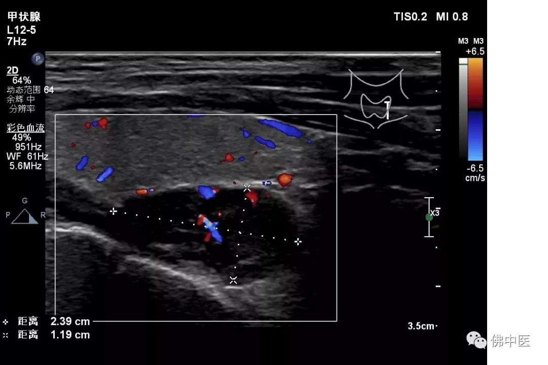 骨质破坏和骨癌诊断,怪病全身肿瘤