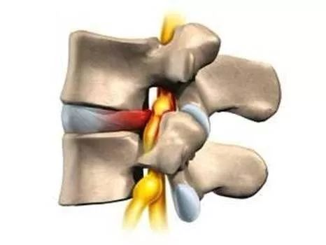 交感神经型颈椎病手术,交感神经型颈椎病会猝死吗