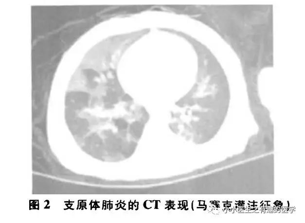ct平扫肺部能查出是哮喘吗,ct平扫肺结节准确吗