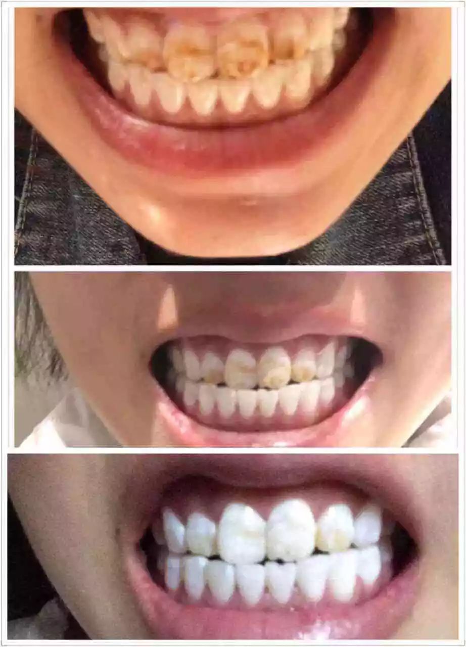 牙黄口臭最好的药,牙黄口臭用什么神器好