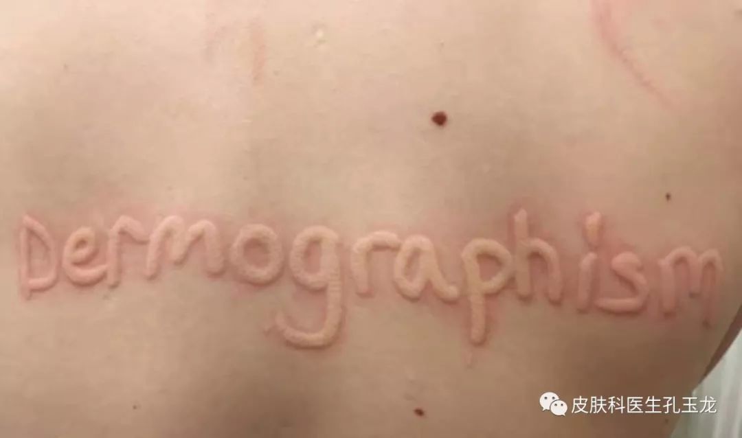 慢性荨麻疹怎么治才能去根,慢性荨麻疹用什么药