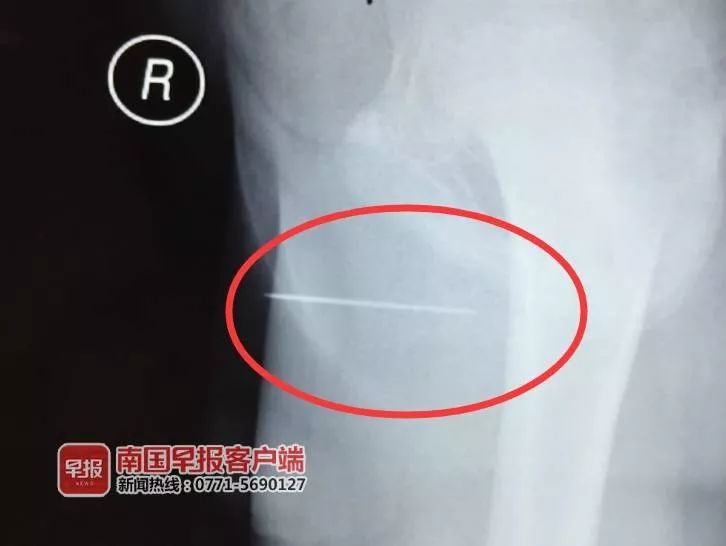 吓人!11岁男孩在家中玩耍,竟将一根4.5厘米长缝衣针塞入*体下**