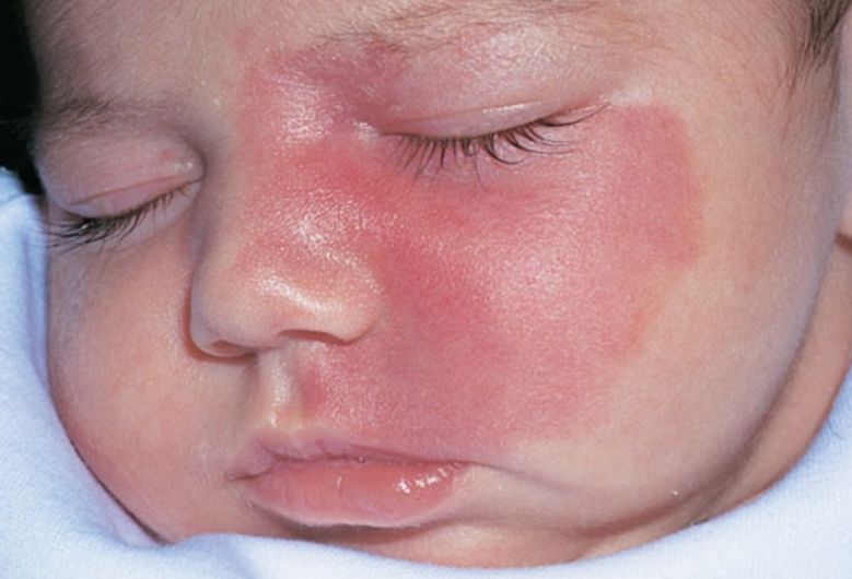 脸上的红血丝怎么处理,脸上的红血丝怎么解决