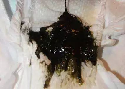 如何辨别宝宝大便颜色是否正常,宝宝所有大便的颜色及症状